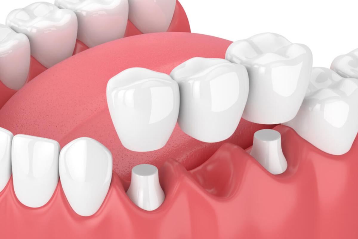 Was müssen sie über zahnmedizinische brücken und partielle zahnprothesen wissen?